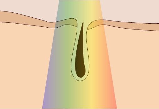 depiltech-articulo-las-contraindicaciones-de-la-luz-pulsada